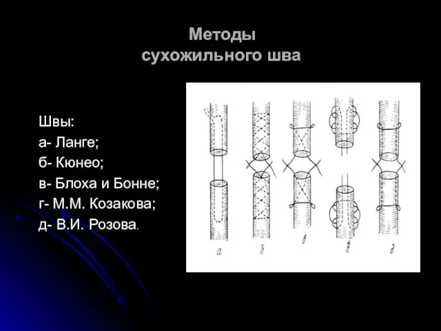 Методы сухожильного шва Швы: а- Ланге; б- Кюнео; в- Блоха и