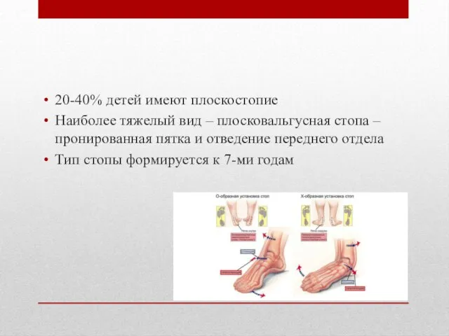 20-40% детей имеют плоскостопие Наиболее тяжелый вид – плосковальгусная стопа –