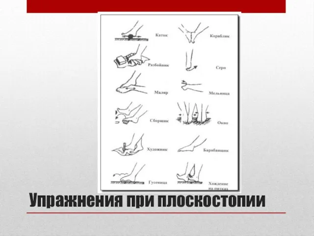 Упражнения при плоскостопии