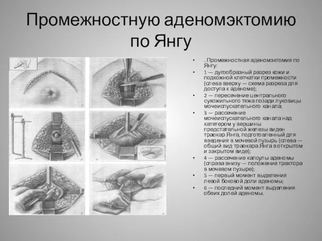 Промежностную аденомэктомию по Янгу . Промежностная аденомэктомия по Янгу: 1 —