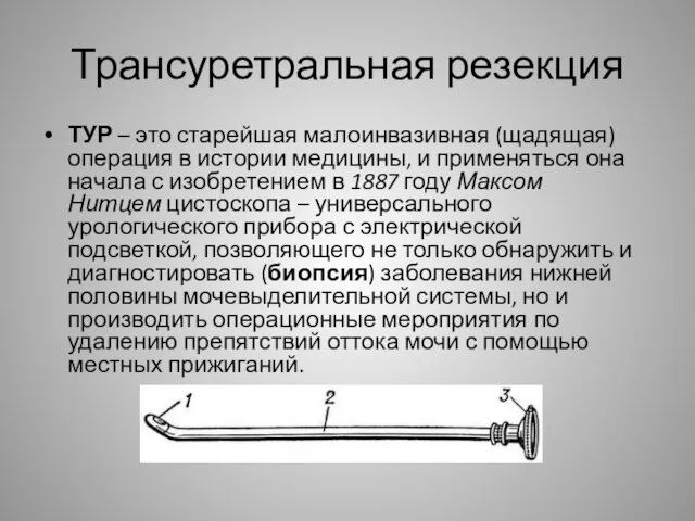 Трансуретральная резекция ТУР – это старейшая малоинвазивная (щадящая) операция в истории