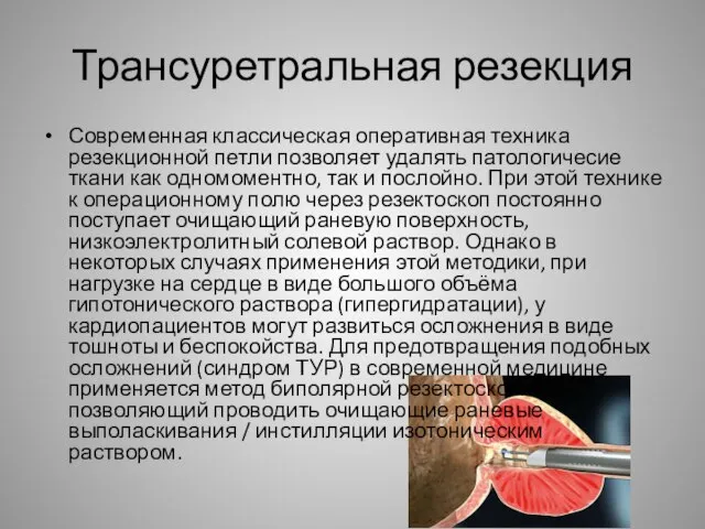 Трансуретральная резекция Современная классическая оперативная техника резекционной петли позволяет удалять патологичесие