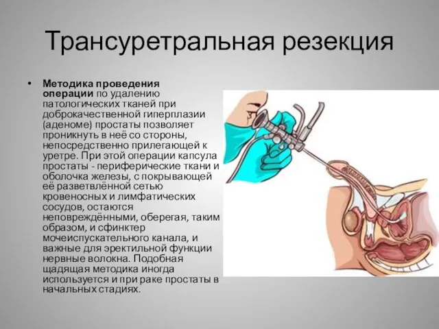 Трансуретральная резекция Методика проведения операции по удалению патологических тканей при доброкачественной