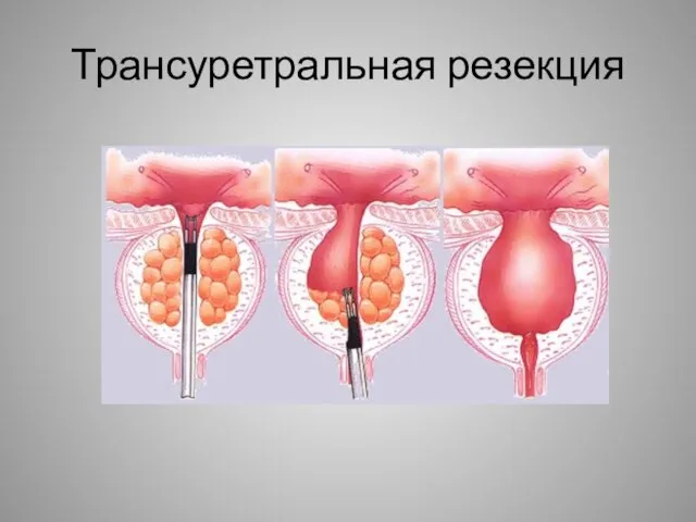 Трансуретральная резекция