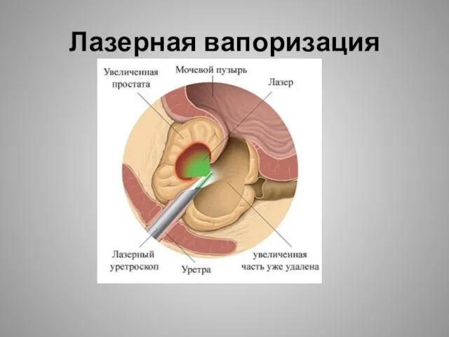 Лазерная вапоризация