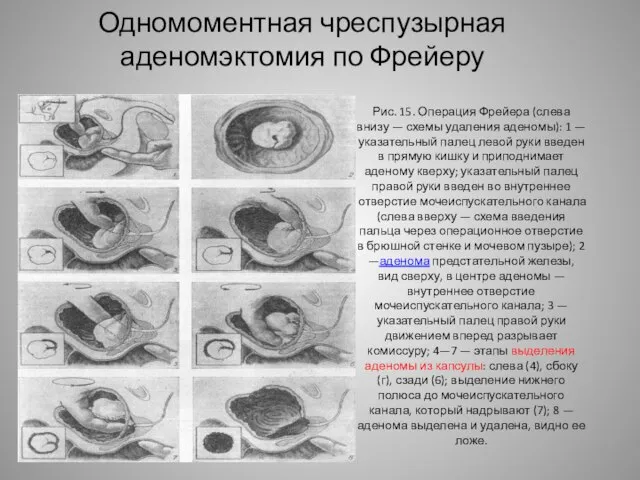 Рис. 15. Операция Фрейера (слева внизу — схемы удаления аденомы): 1