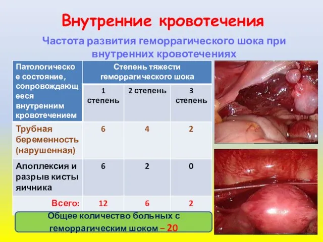 Внутренние кровотечения Частота развития геморрагического шока при внутренних кровотечениях Общее количество