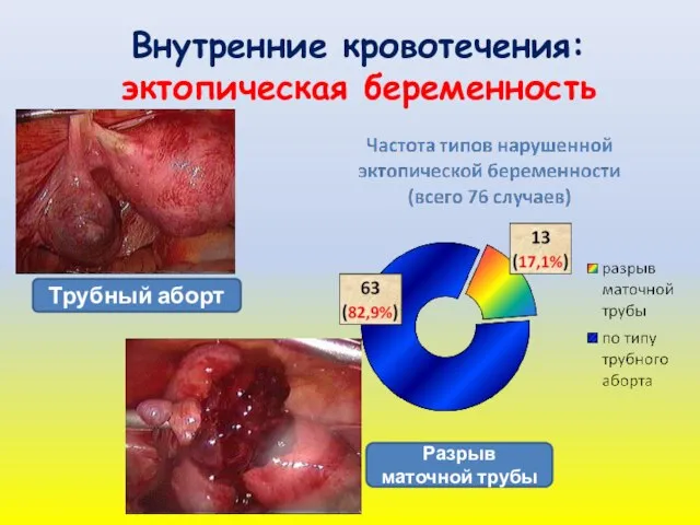 Внутренние кровотечения: эктопическая беременность Трубный аборт Разрыв маточной трубы