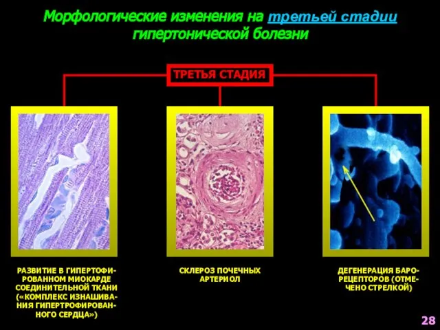 Морфологические изменения на третьей стадии гипертонической болезни ТРЕТЬЯ СТАДИЯ РАЗВИТИЕ В