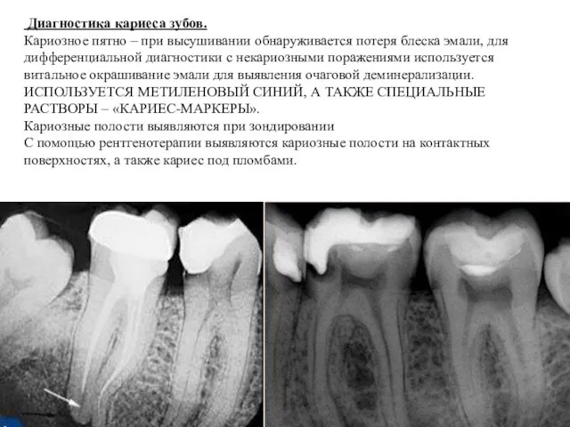 Диагностика кариеса зубов. Кариозное пятно – при высушивании обнаруживается потеря блеска