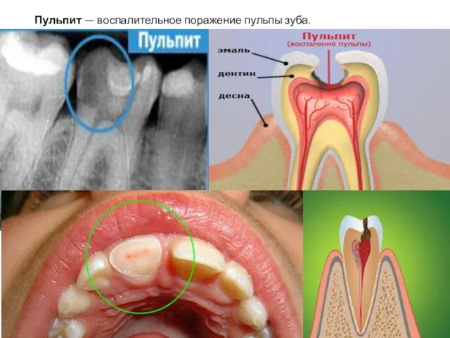 Пульпит — воспалительное поражение пульпы зуба.