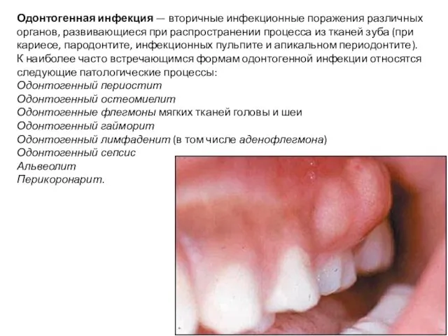 Одонтогенная инфекция — вторичные инфекционные поражения различных органов, развивающиеся при распространении
