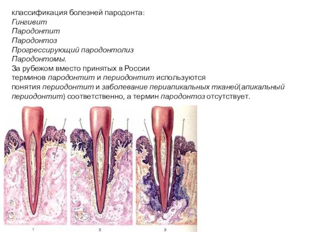 классификация болезней пародонта: Гингивит Пародонтит Пародонтоз Прогрессирующий пародонтолиз Пародонтомы. За рубежом