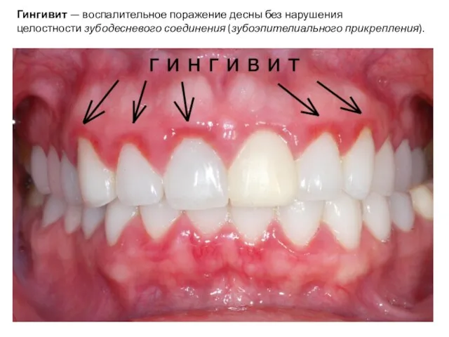 Гингивит — воспалительное поражение десны без нарушения целостности зубодесневого соединения (зубоэпителиального прикрепления).