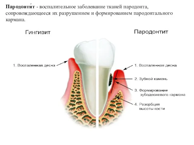 Пародонти́т - воспалительное заболевание тканей пародонта, сопровождающееся их разрушением и формированием пародонтального кармана.