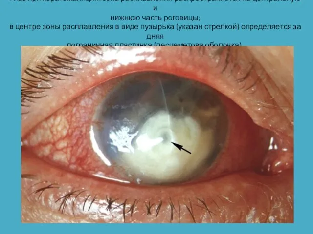 Глаз при кератомаляции: зона расплавления распространяется на центральную и нижнюю часть