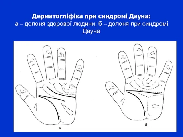 Дерматогліфіка при синдромі Дауна: а – долоня здорової людини; б – долоня при синдромі Дауна