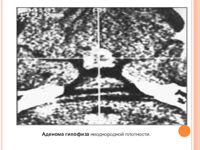 Аденома гипофиза неоднородной плотности.