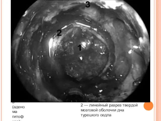 1 - опухоль (аденома гипофиза); 2 — линейный разрез твердой мозговой оболочки дна турецкого седла