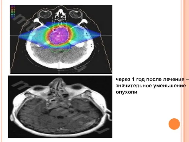 через 1 год после лечения – значительное уменьшение опухоли