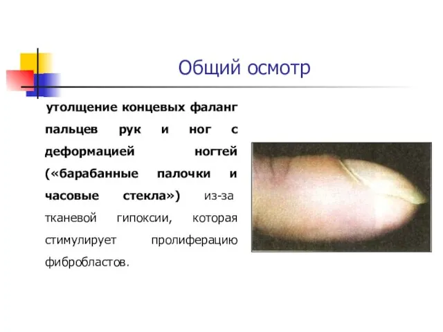 Общий осмотр утолщение концевых фаланг пальцев рук и ног с деформацией