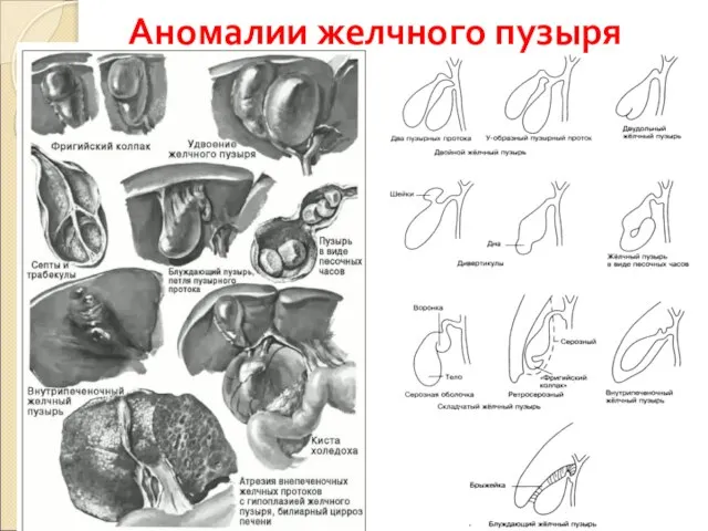 Аномалии желчного пузыря