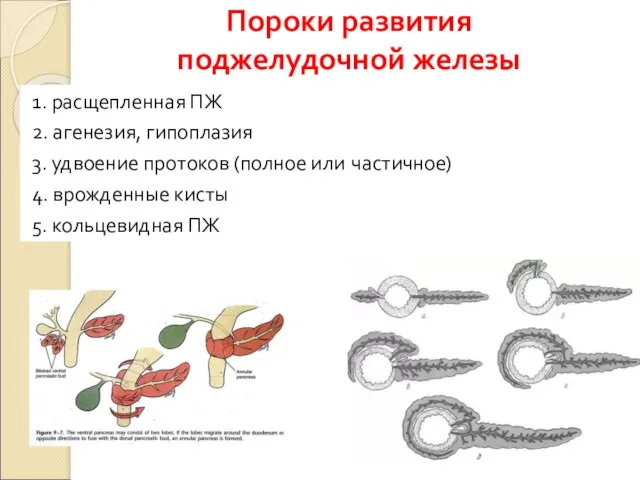 Пороки развития поджелудочной железы 1. расщепленная ПЖ 2. агенезия, гипоплазия 3.