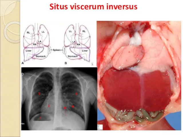 Situs viscerum inversus