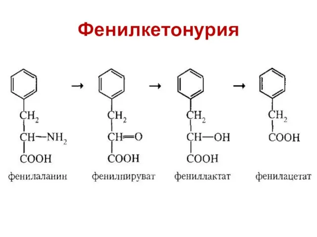 Фенилкетонурия