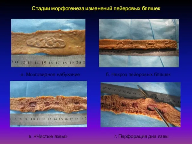 Стадии морфогенеза изменений пейеровых бляшек а. Мозговидное набухание б. Некроз пейеровых