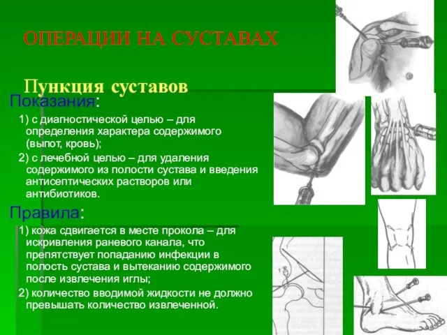 ОПЕРАЦИИ НА СУСТАВАХ Пункция суставов Показания: 1) с диагностической целью –