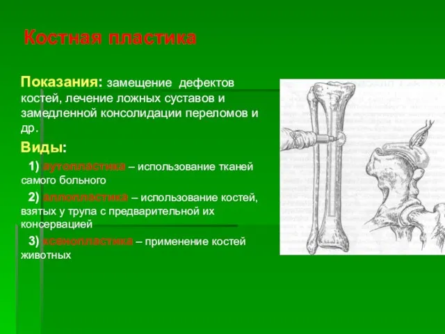 Костная пластика Показания: замещение дефектов костей, лечение ложных суставов и замедленной