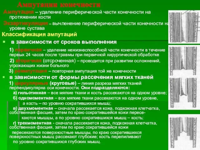 Ампутации конечности Ампутация – удаление периферической части конечности на протяжении кости