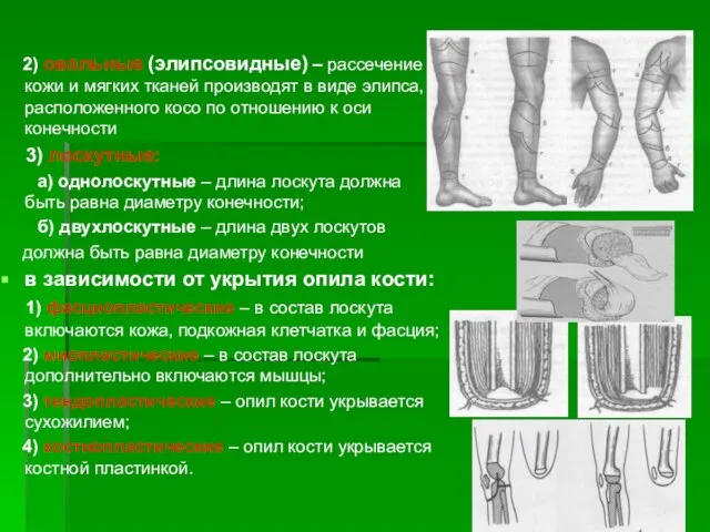 2) овальные (элипсовидные) – рассечение кожи и мягких тканей производят в