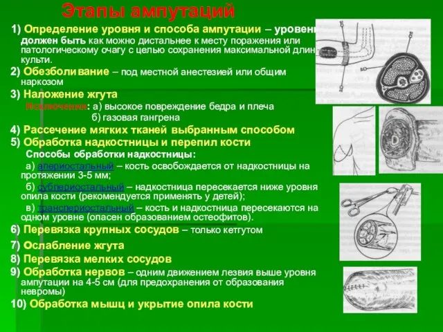 Этапы ампутаций 1) Определение уровня и способа ампутации – уровень должен