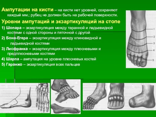 Ампутации на кисти – на кисти нет уровней, сохраняют каждый мм.;