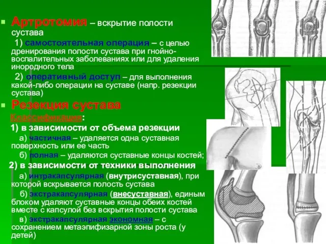 Артротомия – вскрытие полости сустава 1) самостоятельная операция – с целью