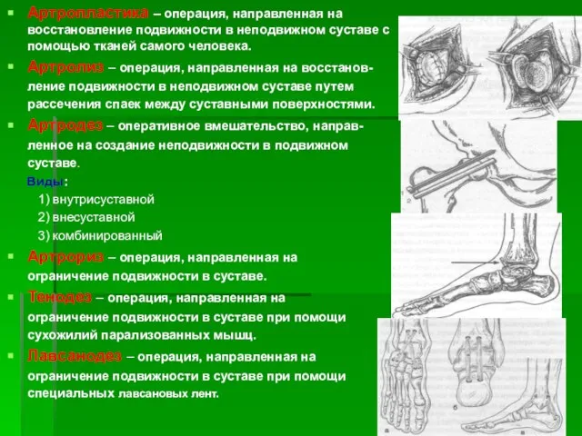 Артропластика – операция, направленная на восстановление подвижности в неподвижном суставе с