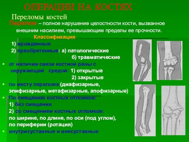 ОПЕРАЦИИ НА КОСТЯХ Переломы костей Перелом – полное нарушение целостности кости,