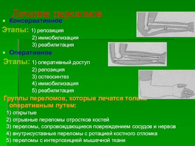 Лечение переломов Консервативное Этапы: 1) репозиция 2) иммобилизация 3) реабилитация Оперативное