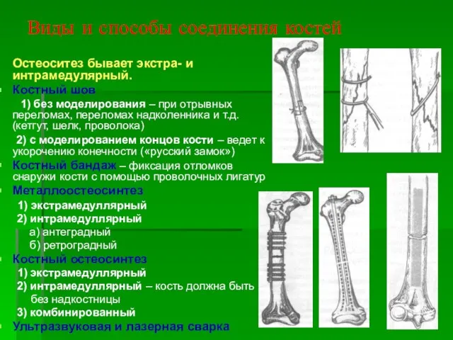 Виды и способы соединения костей Остеоситез бывает экстра- и интрамедулярный. Костный