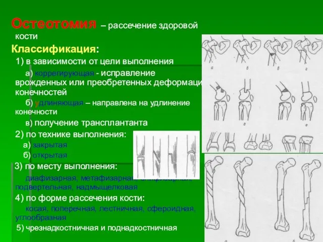 Остеотомия – рассечение здоровой кости Классификация: 1) в зависимости от цели