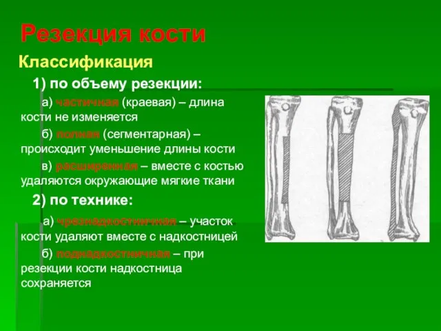 Резекция кости Классификация 1) по объему резекции: а) частичная (краевая) –