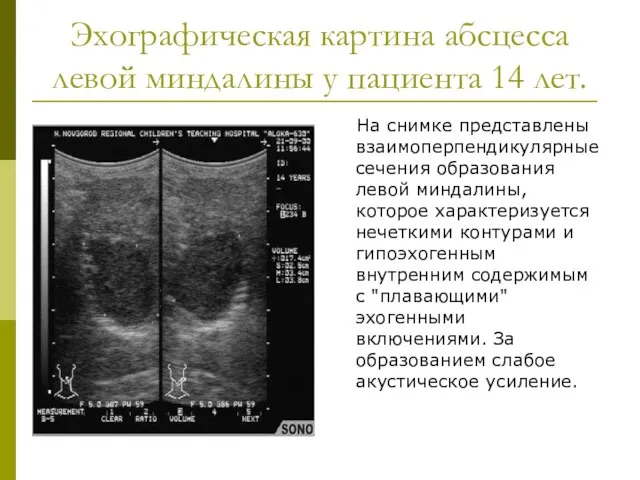 Эхографическая картина абсцесса левой миндалины у пациента 14 лет. На снимке