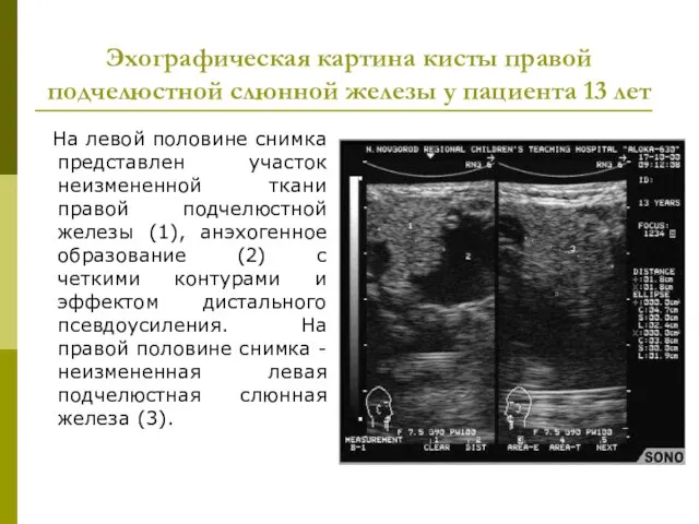 Эхографическая картина кисты правой подчелюстной слюнной железы у пациента 13 лет