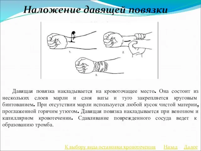 Давящая повязка накладывается на кровоточащее место. Она состоит из нескольких слоев