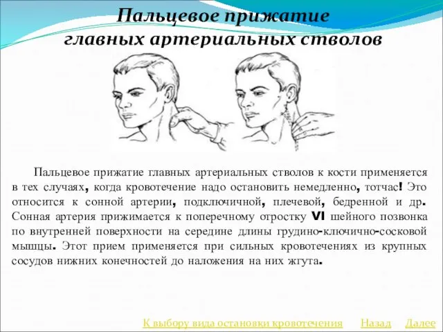 Пальцевое прижатие главных артериальных стволов Пальцевое прижатие главных артериальных стволов к