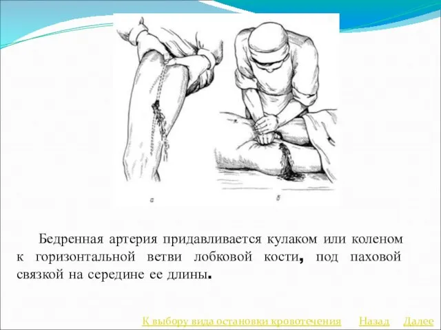Далее К выбору вида остановки кровотечения Назад Бедренная артерия придавливается кулаком