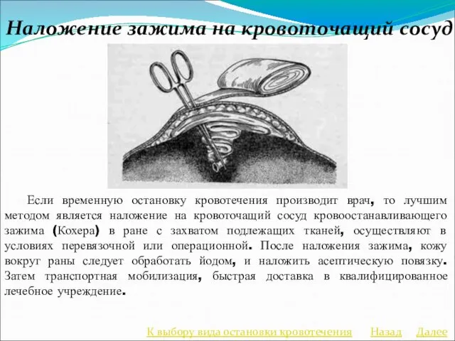 Наложение зажима на кровоточащий сосуд Если временную остановку кровотечения производит врач,