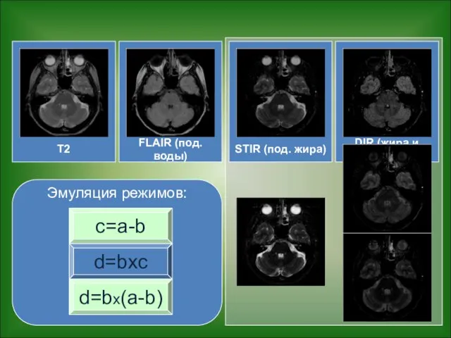 T2 FLAIR (под. воды) DIR (жира и воды) STIR (под. жира) Эмуляция режимов: d=bx(a-b) c=a-b d=bxc